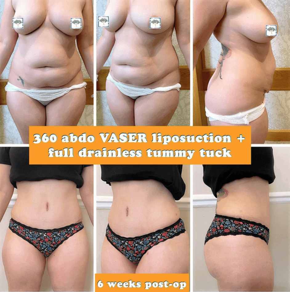 vaser lipo and drainless tummy tuck at The Harley Clinic, London