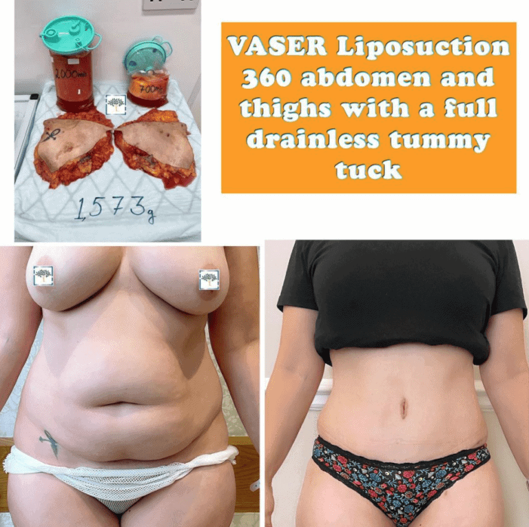 vaser liposuction before and after and full drainless tummy tuck at The Harley Clinic, London