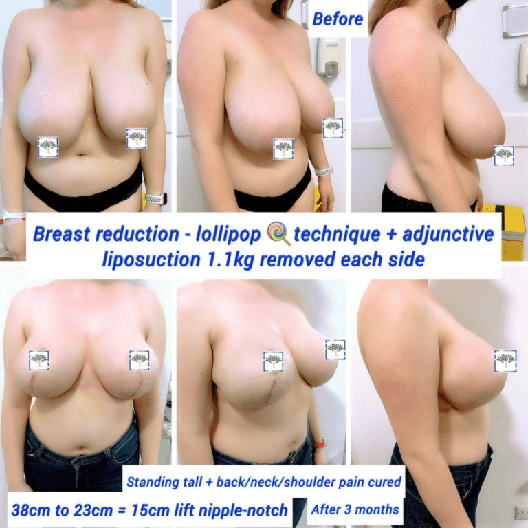Breast reduction before and after, lollipop technique and liposuction at The Harley Clinic, London