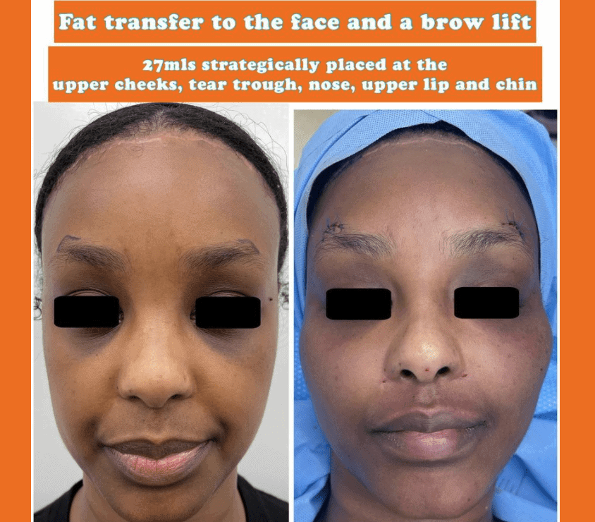 Fat transfer to the face and a brow lift at The Harley Clinic, London