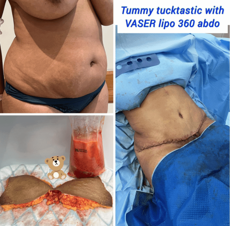 Tummy tuck with Vaser liposuction 360 at The Harley Clinic