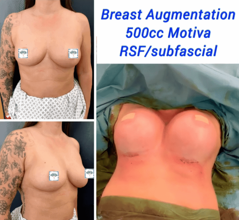 Breast Augmentation, 500cc Motiva RSF/subfascial at The Harley Clinic, London