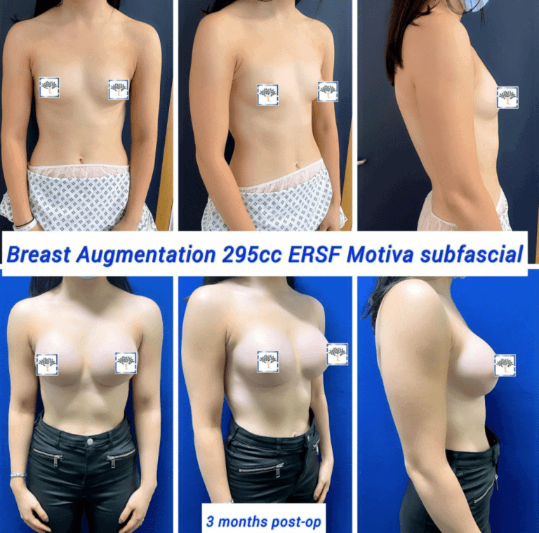 Breast augmentation at The Harley Clinic - 3 months post op