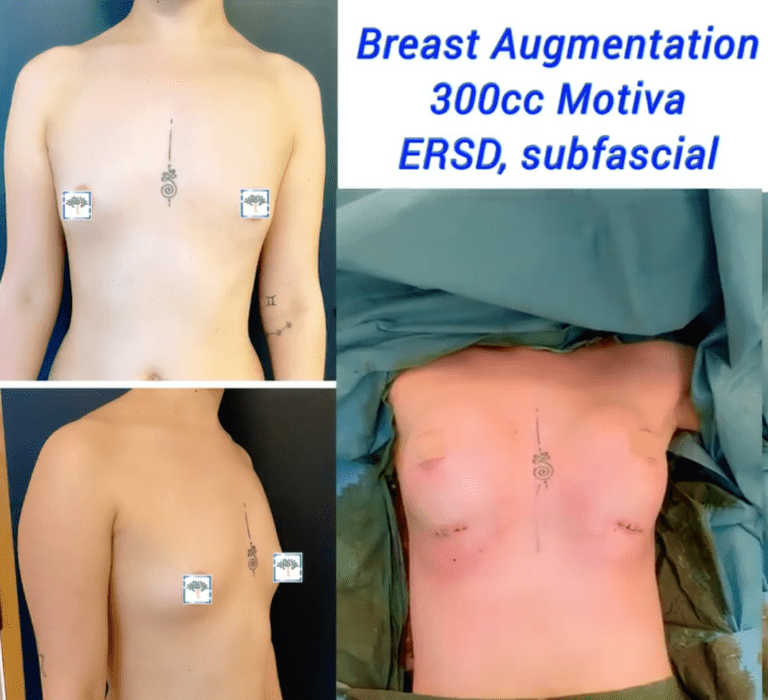 Breast Augmentation, 300cc Motiva, ERSD, subfascial