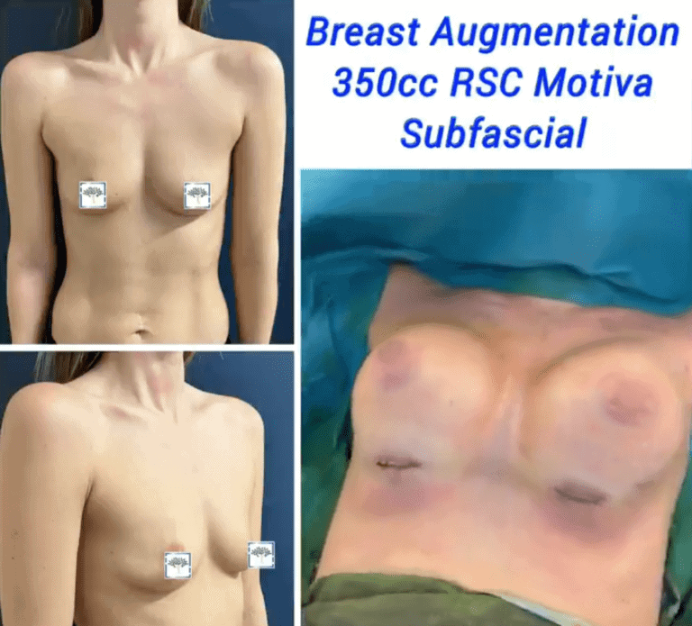 Breast augmentation at The Harley Clinic, London