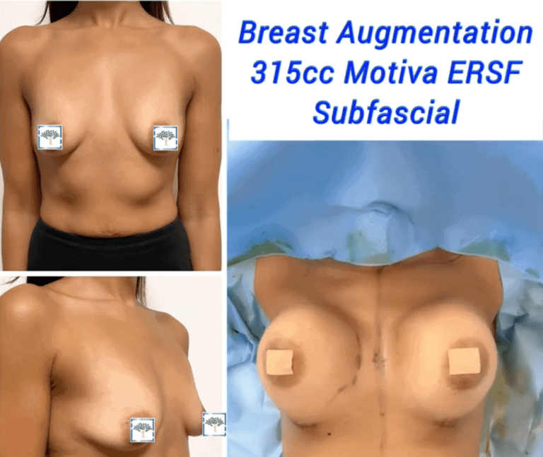 Breast augmentation 315cc Motiva ERSF Subfascial