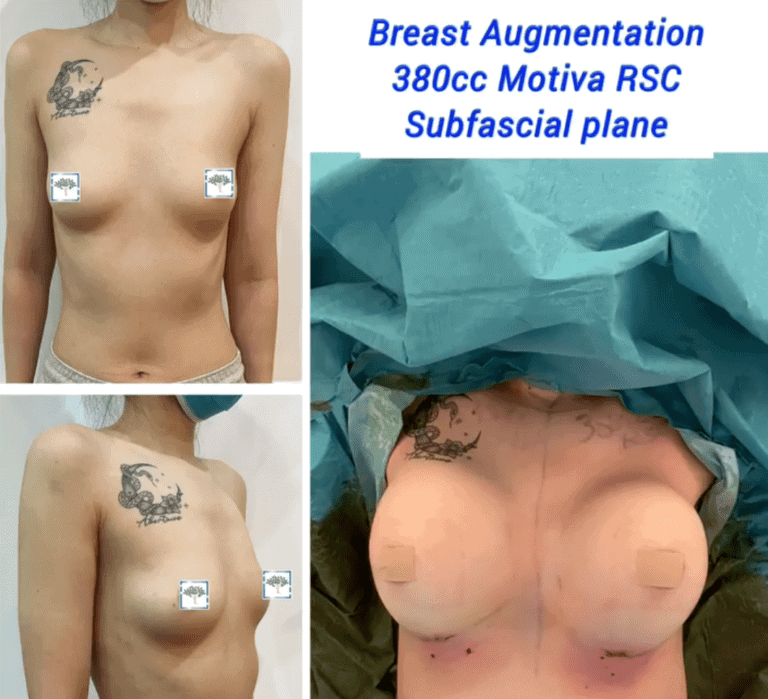 Breast Augmentation, 380cc Motiva RSC subfascial plane