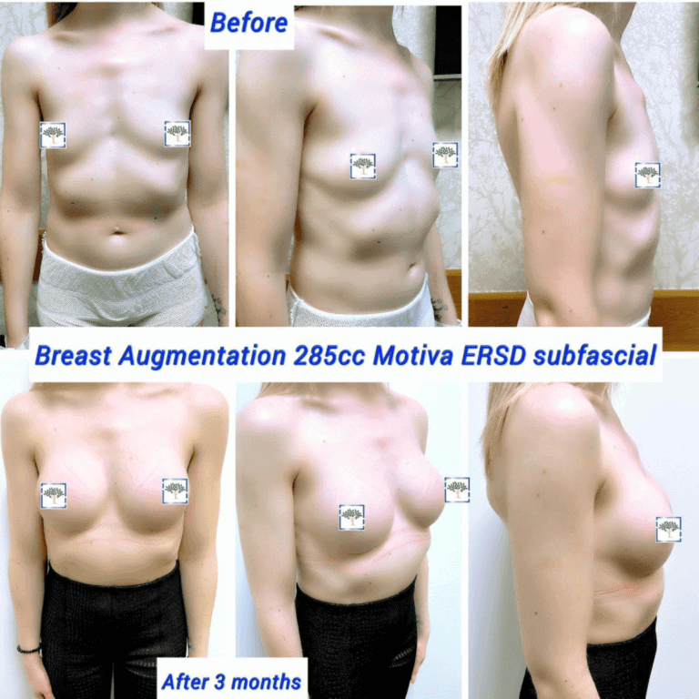 Before and after breast augmentation 285cc Motiva ERSD
