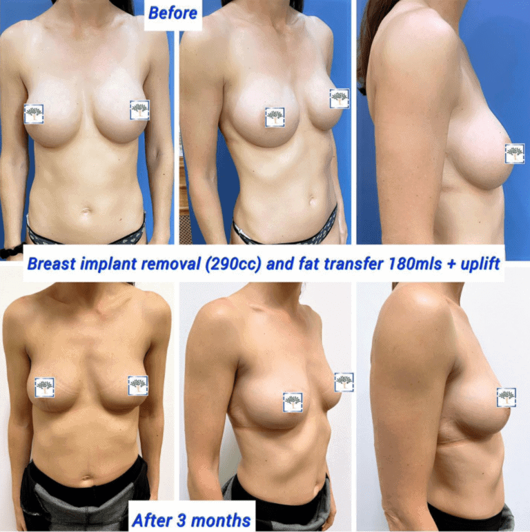 Before and after hybrid breast augmentation, breast implant removal, breast fat transfer, and uplift at The Harley Clinic, London