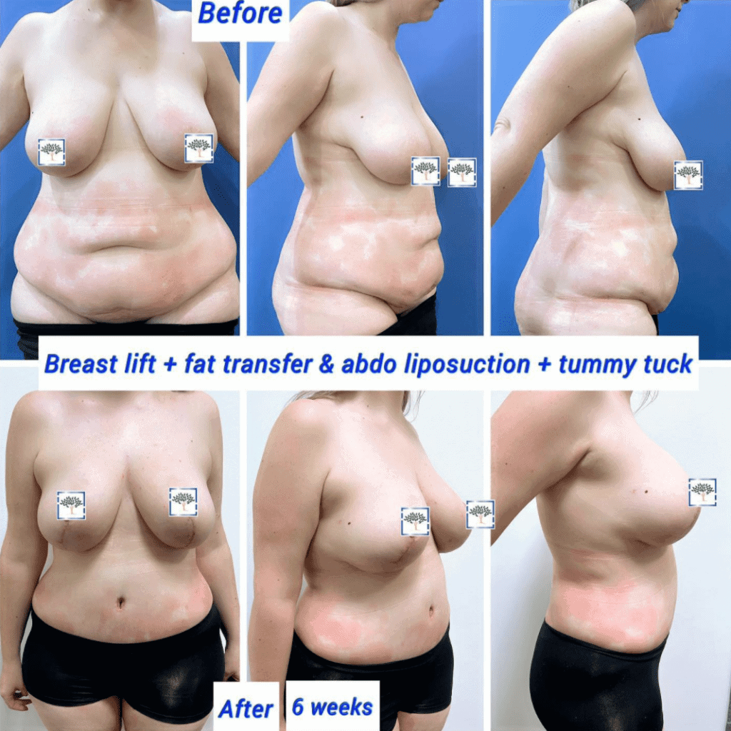 Breast lift with fat transfer, liposuction, and tummy tuck before and after at The Harley Clinic, London
