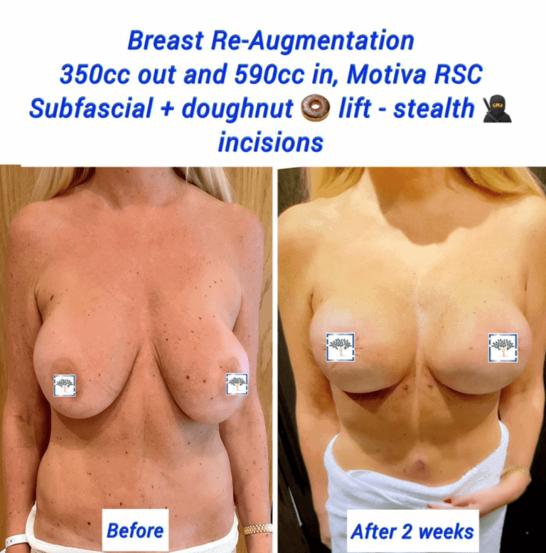 Breast re-augmentation and doughnut lift at The Harley Clinic