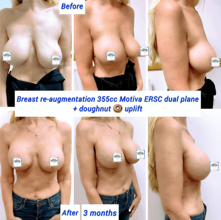 Breast re-augmentation, 355c Motiva, doughnut uplift at the Harley Clinic, London