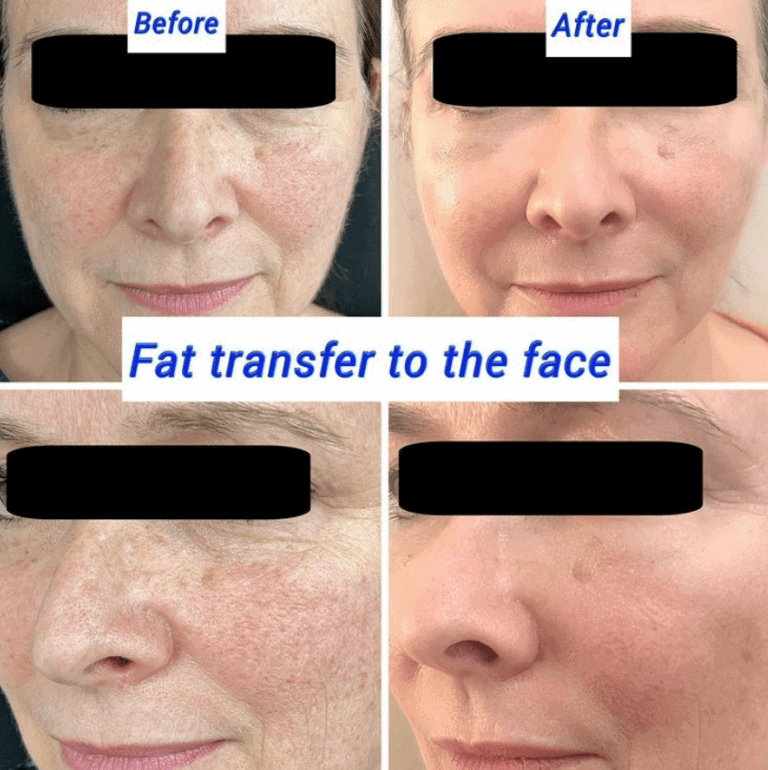 Before and after fat transfer to the face at The Harley Clinic, London