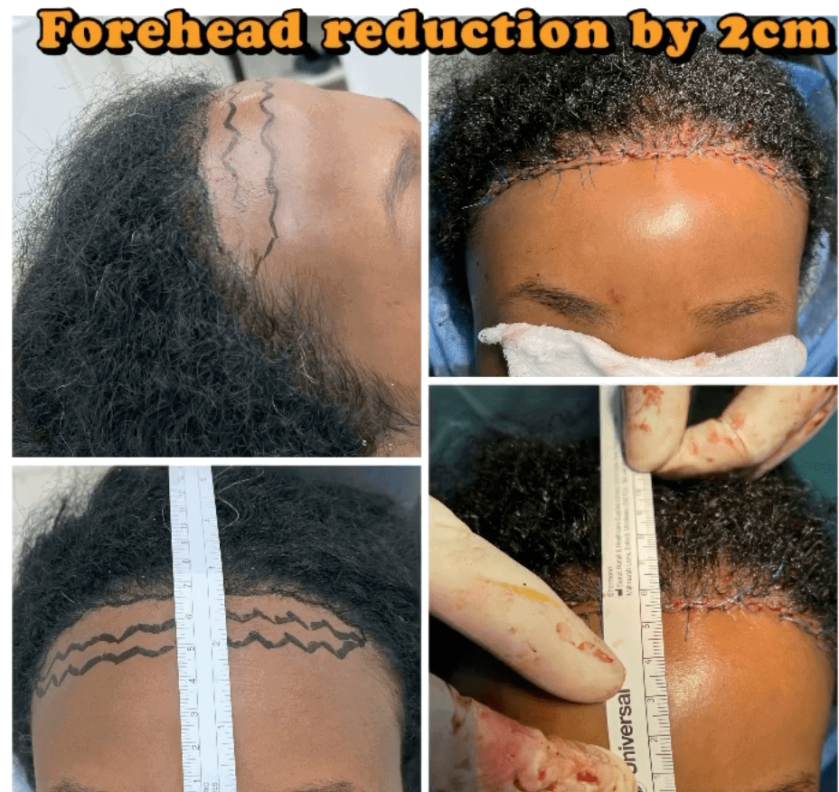 Forehead Reduction Surgery - Harley Clinic