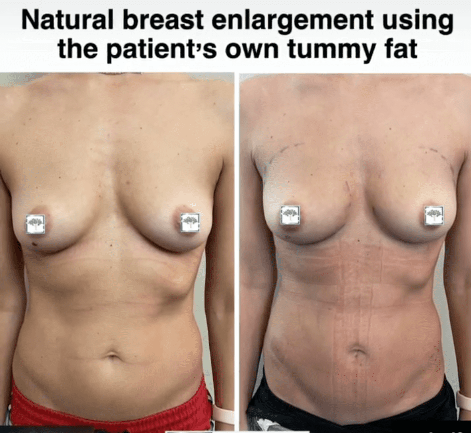 antes y después de la transferencia de grasa mamaria en Harley Clinic London