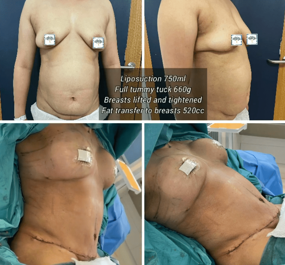before and after mummy makeover including liposuction, tummy tuck, breast lift, and breast fat transfer at The Harley Clinic London