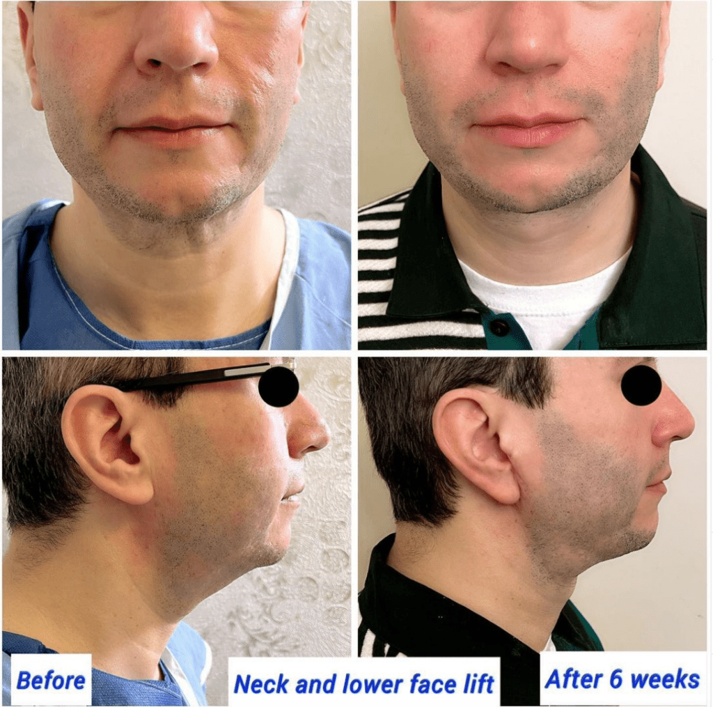 before and after a neck and lower facelift at The Harley Clinic