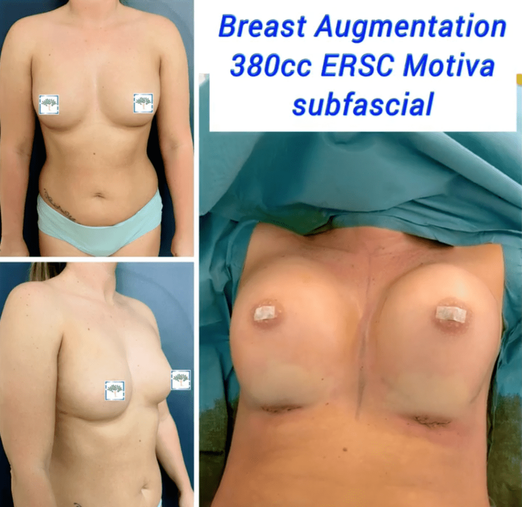 Is there a Breast Augmentation Age Limit? Breast augmentation 380cc at The Harley Clinic