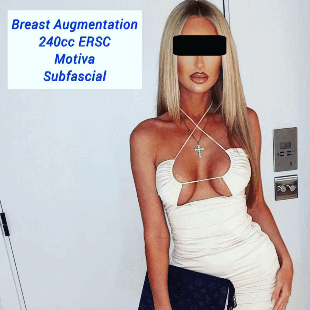 Exercise after Breast Augmentation, 240cc ERSC Motiva Subfascial breast implants at The Harley Clinic, London