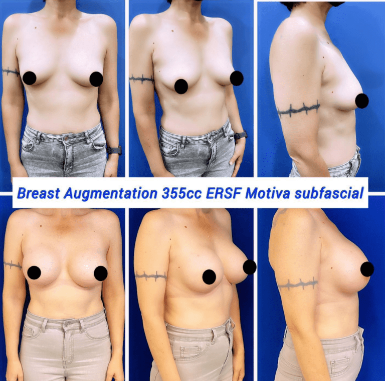 Breast augmentation 355cc ERSF Motiva Subfascial