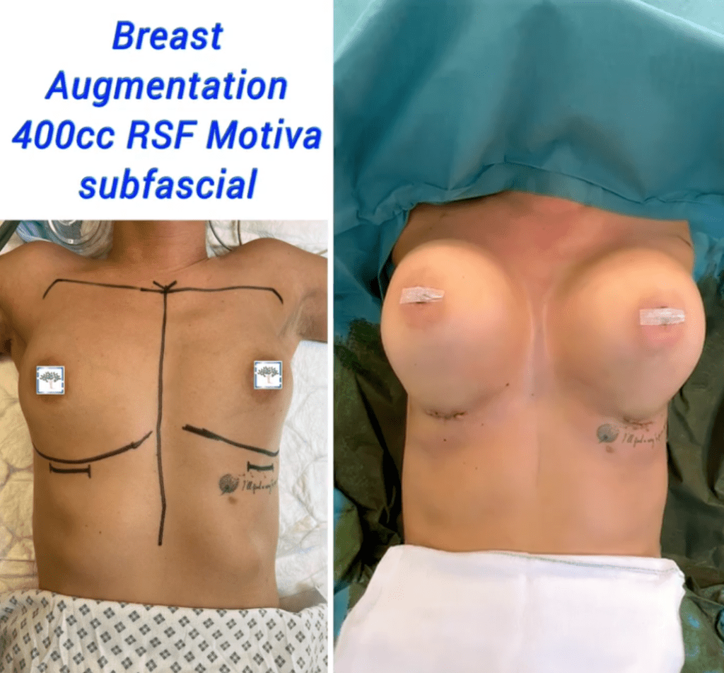 Prepare for Breast Augmentation Surgery: Breast augmentation 400cc at The Harley Clinic - how to prepare for breast augmentation