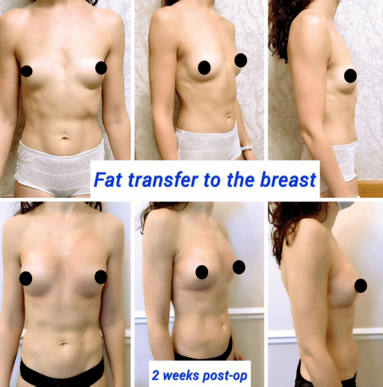 fat transfer to the breast 2 weeks post-op at The Harley Clinic, London
