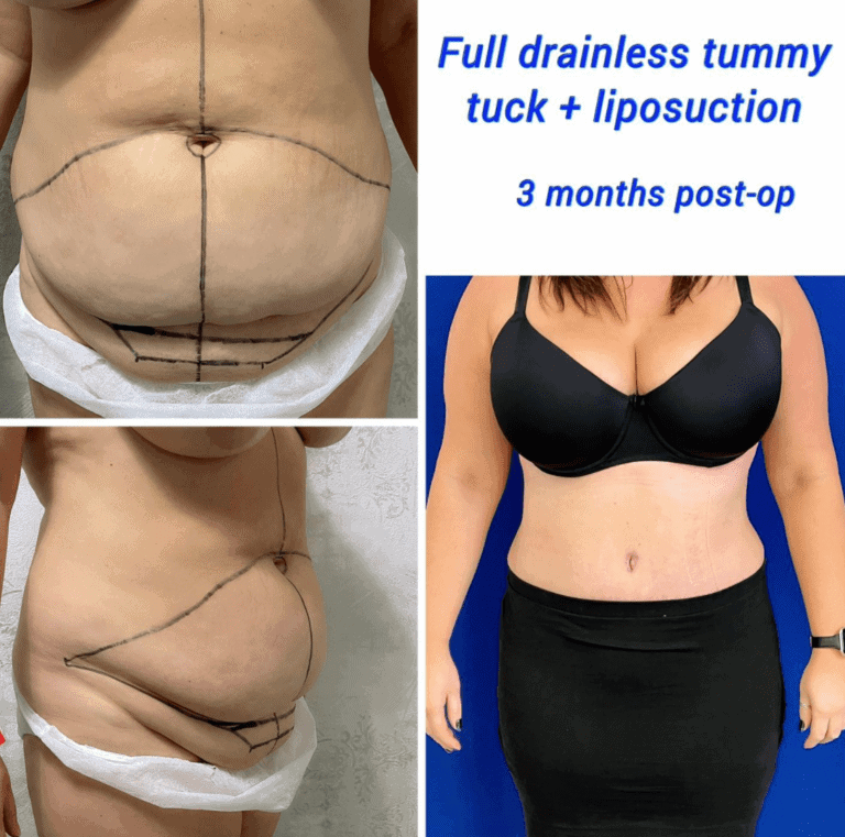 Full drainless tummy tuck recovery and liposuction at The Harley Clinic