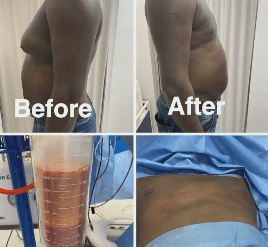 Before and after male breast reduction surgery at The Harley Clinic