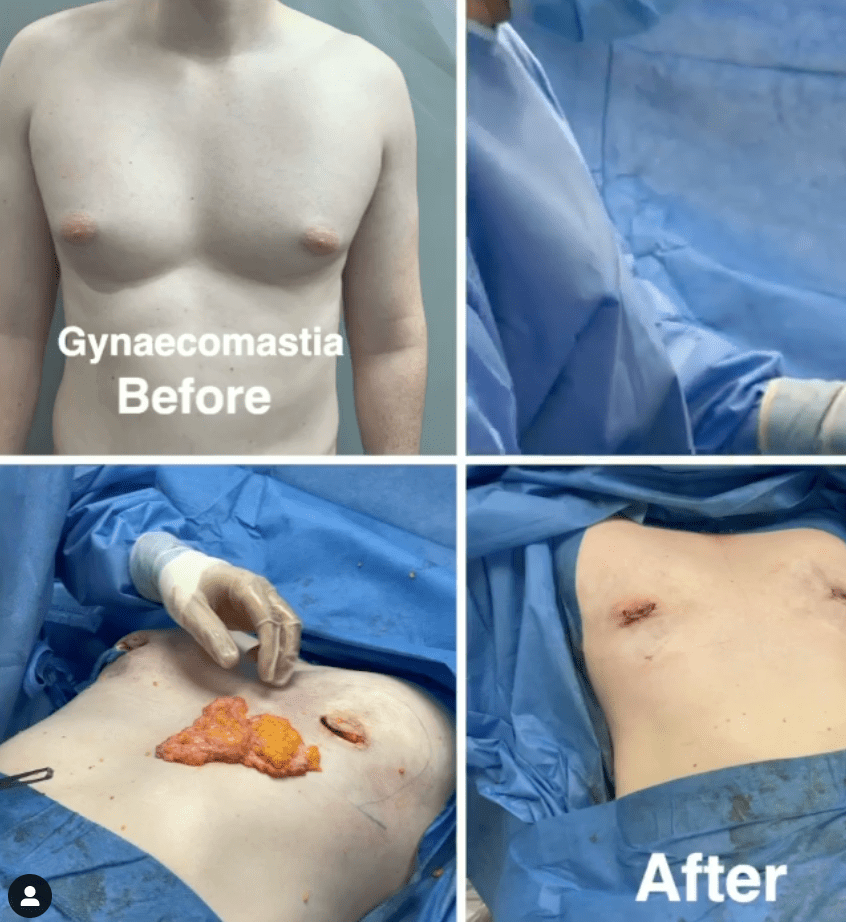 Gynaecomastia Recovery Time: Male breast reduction surgery at The Harley Clinic, London