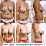Mummy makeover, breast augmentation, uplift, liposuction, full tummy tuck, and mole removal 3 months post-op at The Harley Clinic