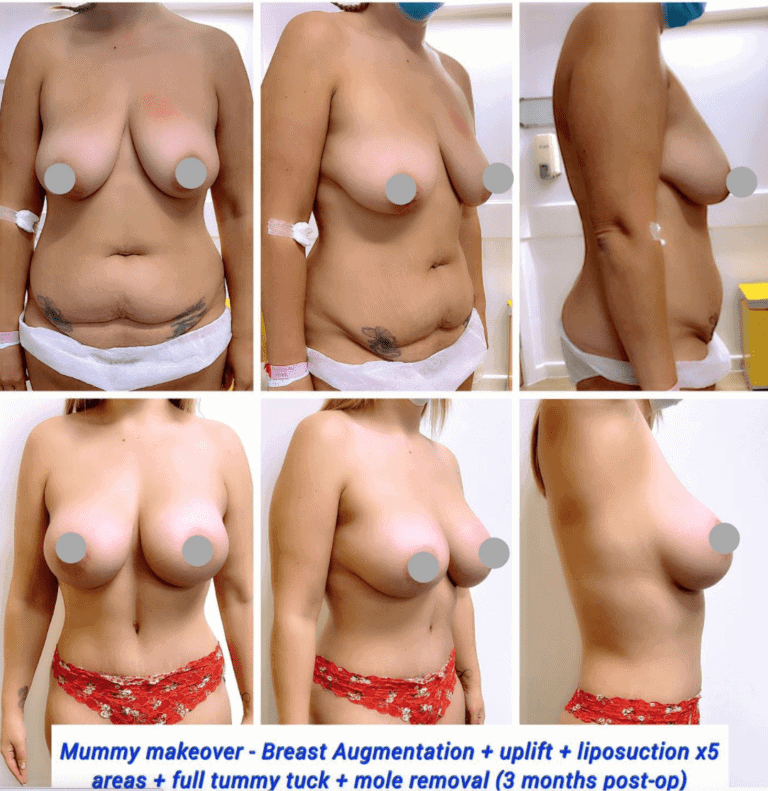Mummy makeover, breast augmentation, uplift, liposuction, full tummy tuck, and mole removal 3 months post-op at The Harley Clinic