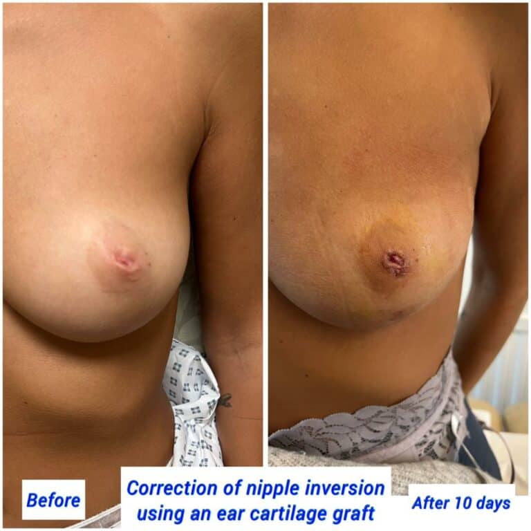 Before and after correction of nipple inversion using ear cartilage graft at The Harley Clinic