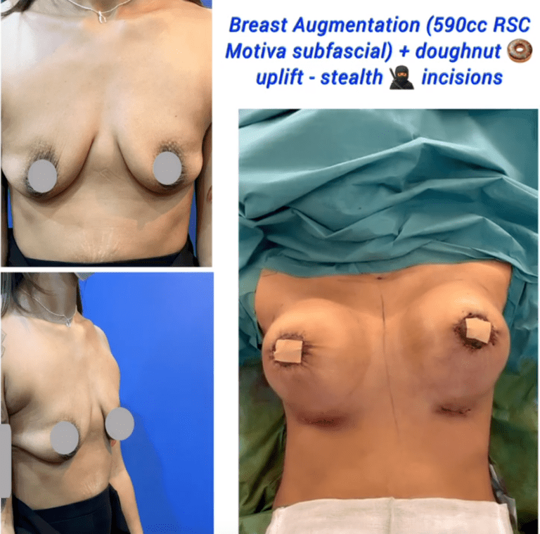 Breast augmentation and breast lift at the Harley Clinic London