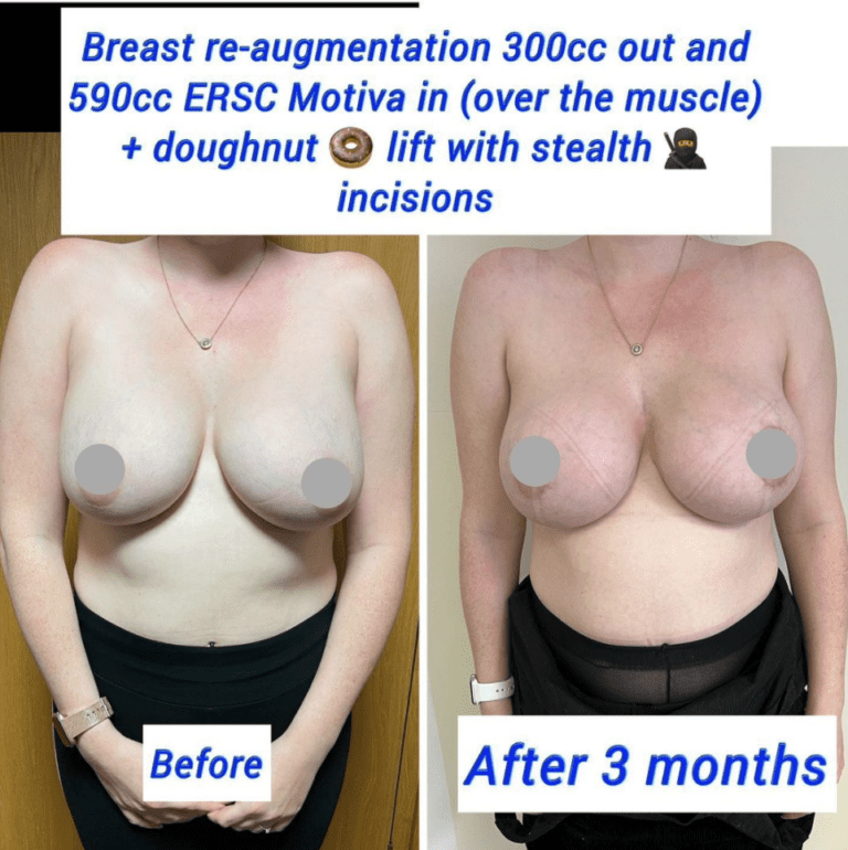 Before and after breast lift with implants at the Harley Clinic London
