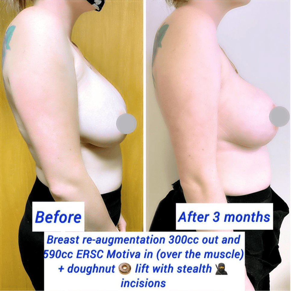 Before and after breast lift surgery with implants at the Harley Clinic London