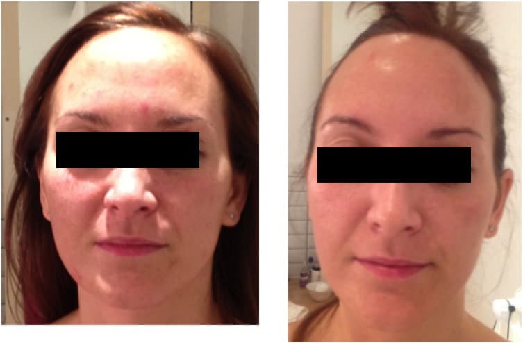 Before and after LED light therapy