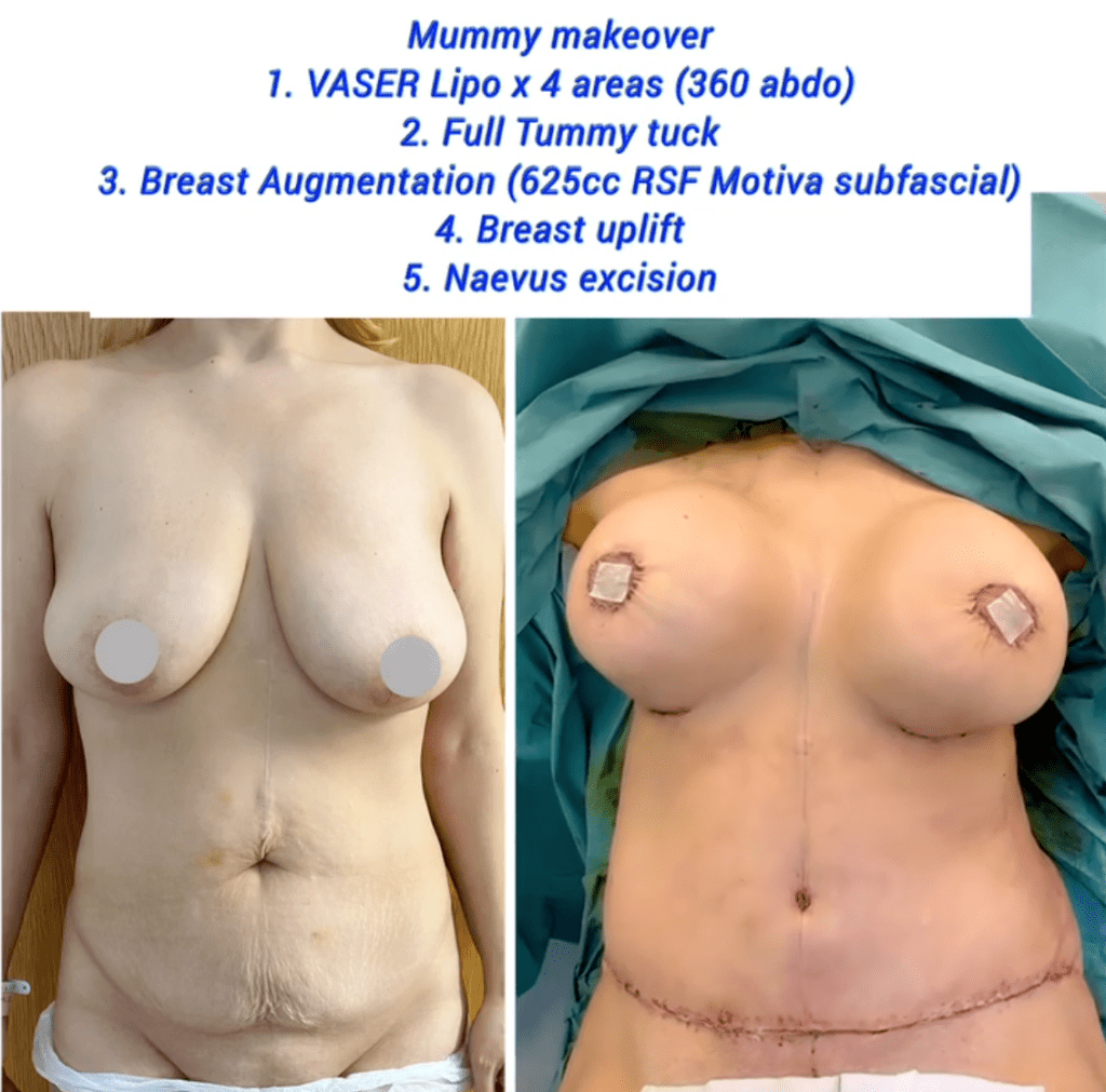 Mummy makeover recovery at the Harley Clinic (VASER lipo, tummy tuck, breast augmentation, breast uplift, and neavus excision)