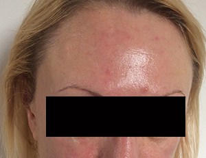 Redness after Dermalux light therapy