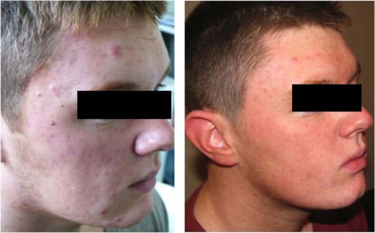 Before and after acne Dermalux flex