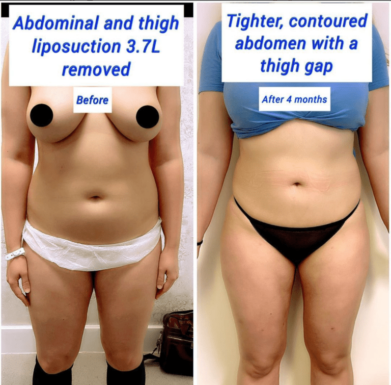 abdominal and thigh liposuction before and after