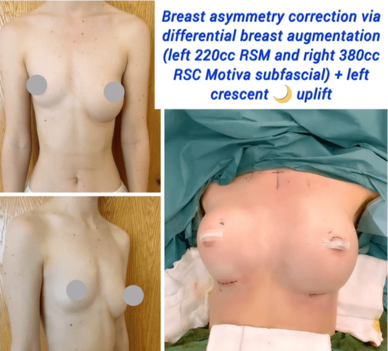 Breast asymmetry correction at the Harley Clinic London
