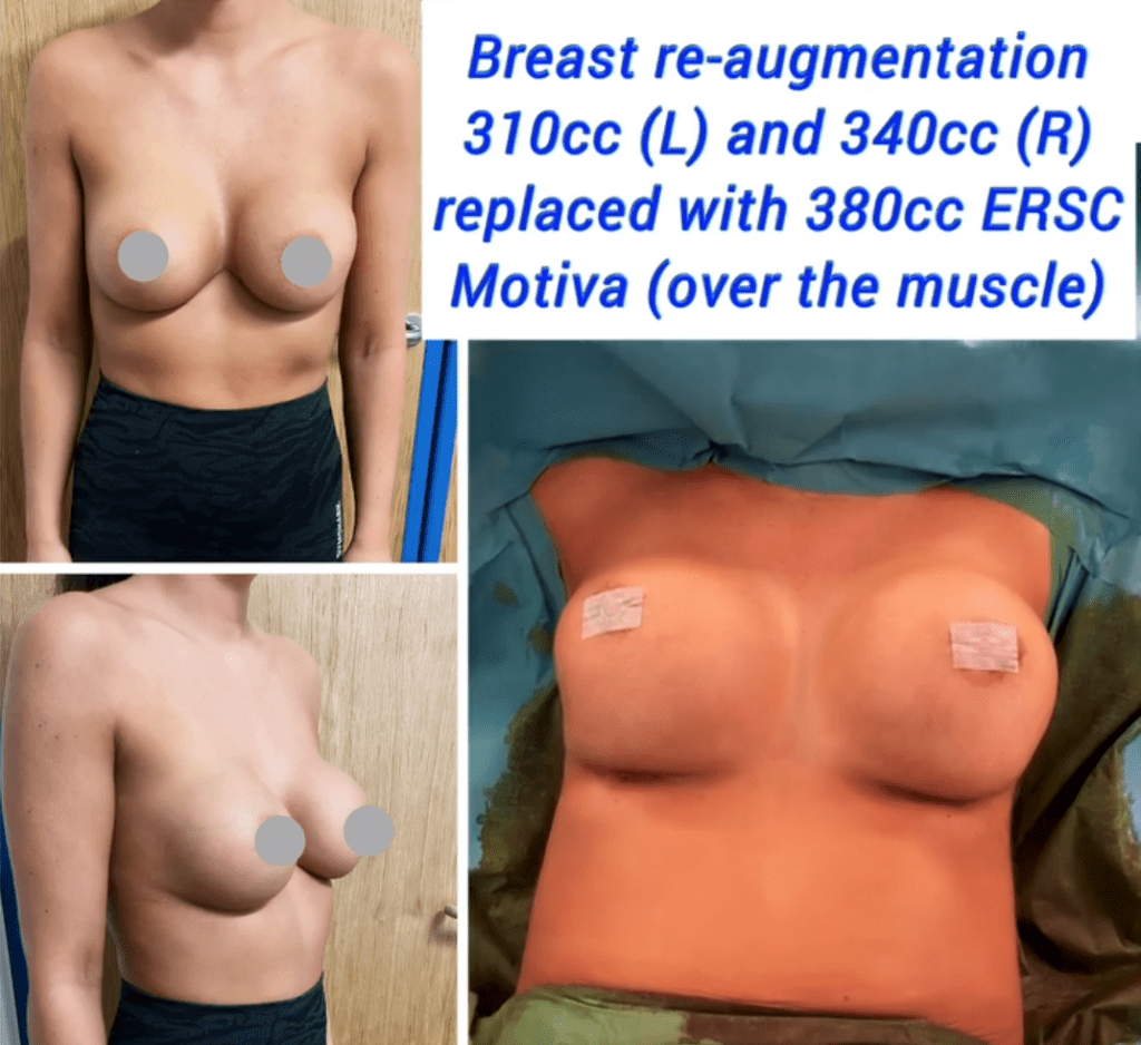 Breast re-augmentation replaced with 380cc Motiva over the muslce, the Harley Clinic