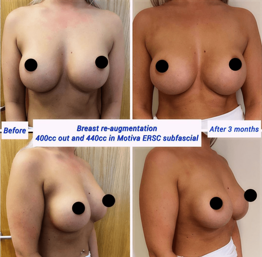 breast re augmentation at The Harley Clinic