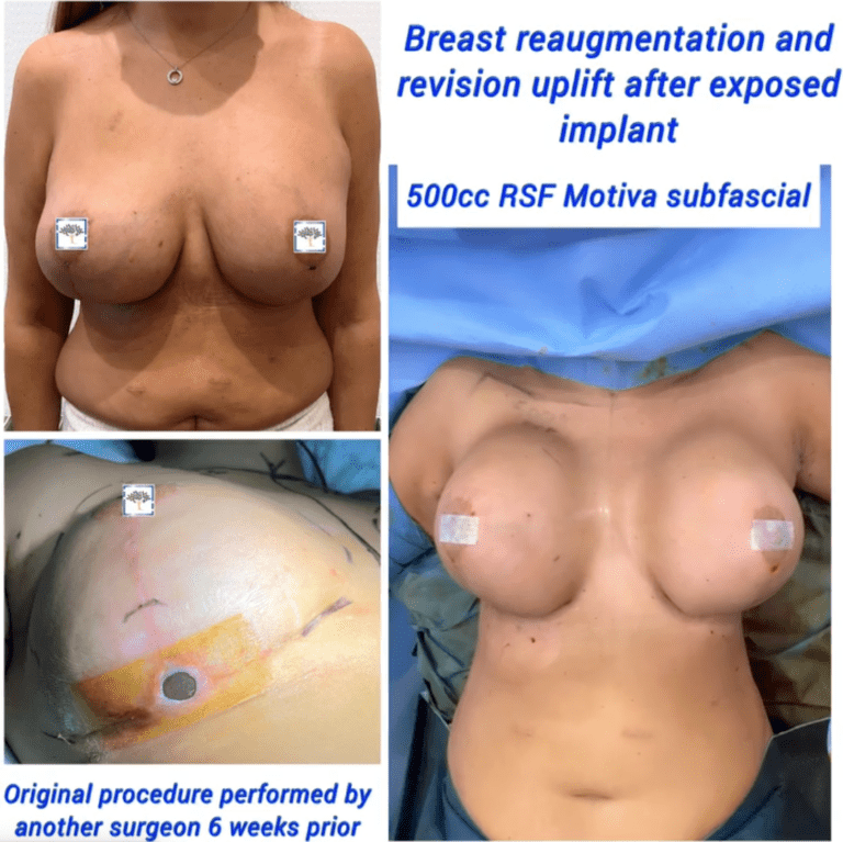 Breast re augmentation and uplift at The Harley Clinic