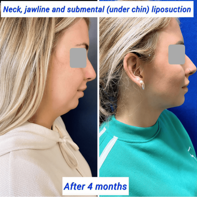 Neck treatment: Before and after neck, jawline, and under chin liposuction at the Harley Clinic London