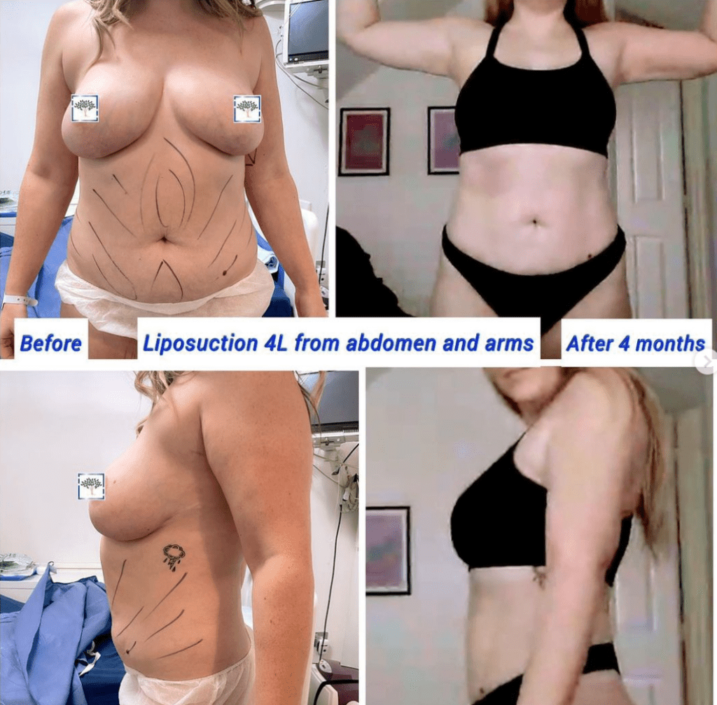 Liposucción de abdomen y brazos antes y después en The Harley Clinic