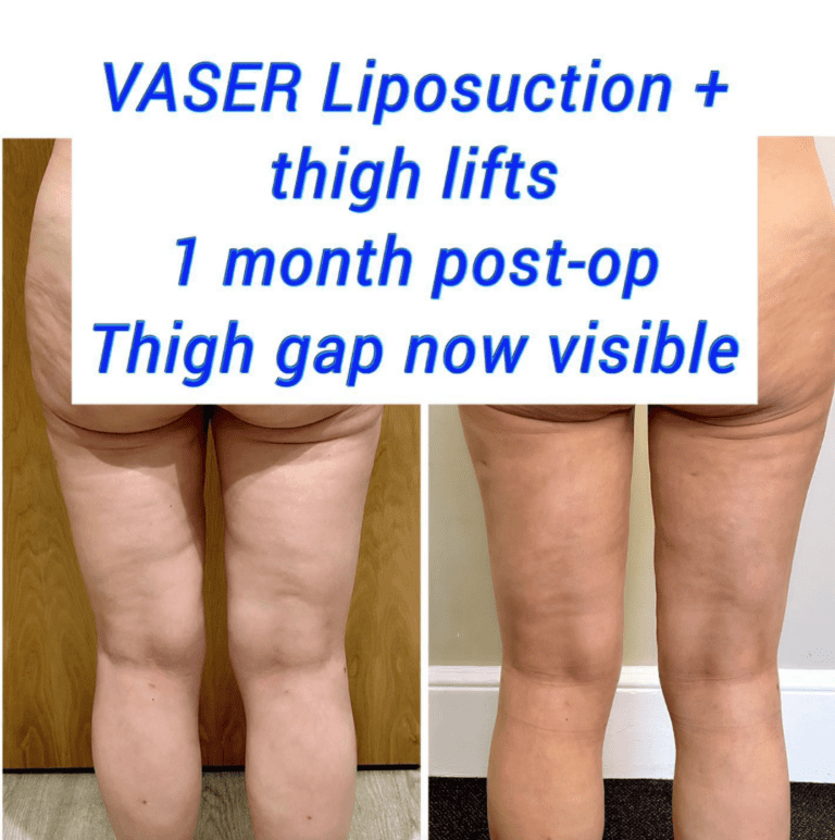 Vaser liposuction and thigh lift before and after at the Harley Clinic