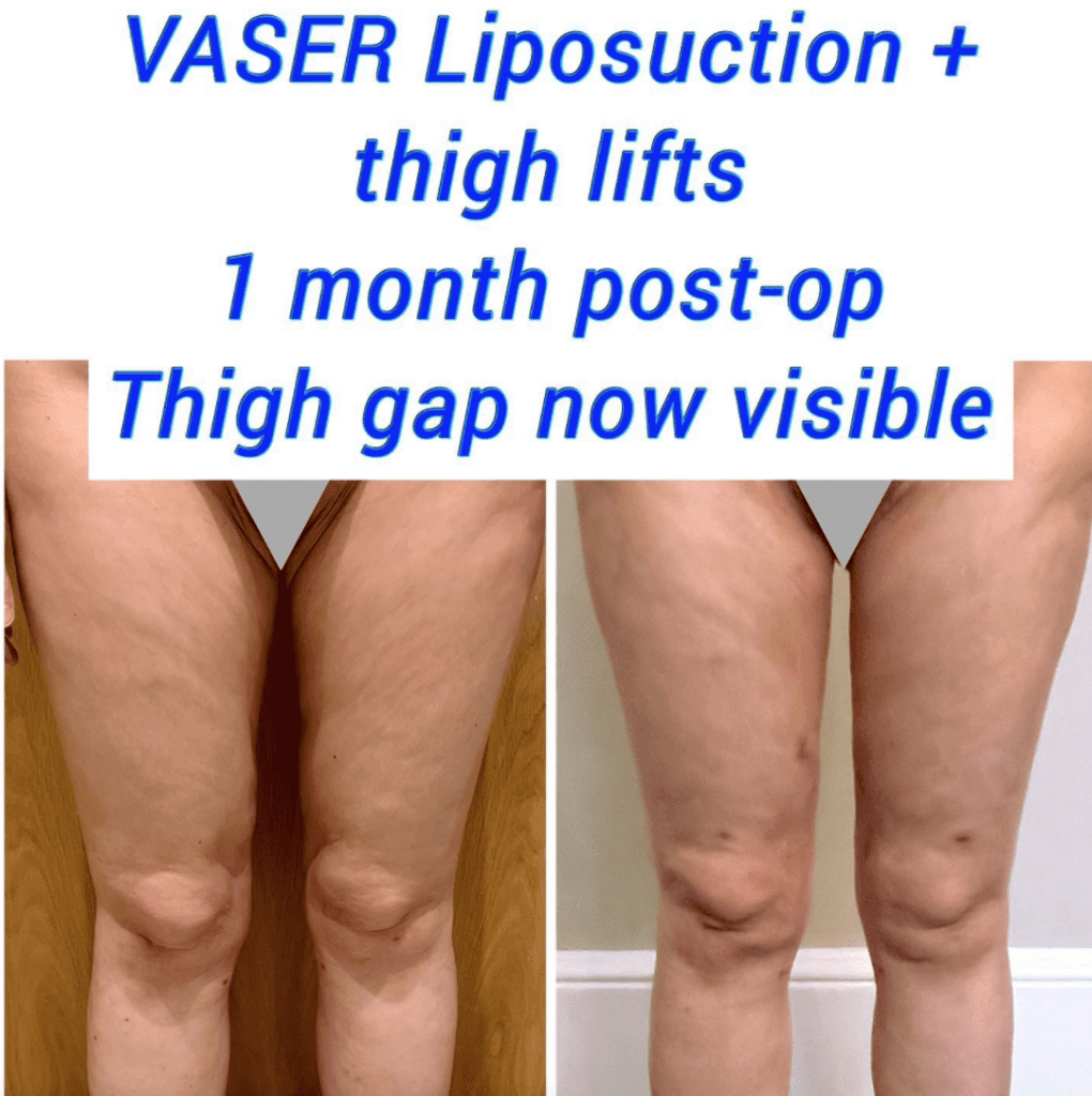 Tipos de liposucción: liposucción Vaser y levantamiento de muslos antes y después en Harley Clinic