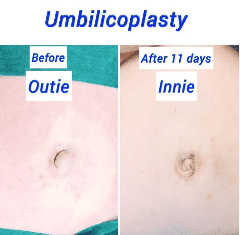 umbilicoplasty at The Harley Clinic, Harley Street