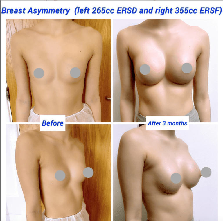 Breast asymmetry correction at the Harley Clinic London